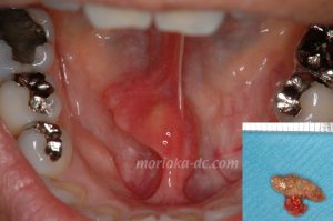 顎下腺管に発生した唾石と摘出したもの。
