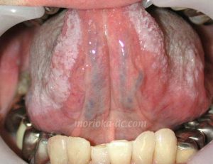 常在菌であるカンジダが舌に菌塊形成したもの。
抗真菌薬の投与で消失します。