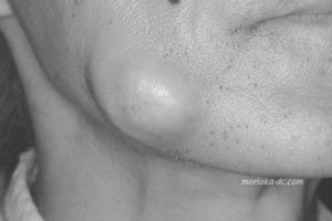 cheek_abs1_wm_BW