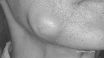 cheek_abs1_wm_BW