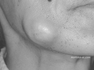 cheek_abs1_wm_BW