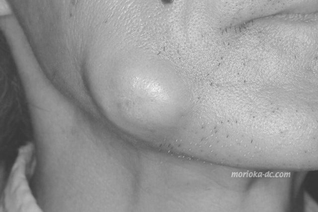 cheek_abs1_wm_BW