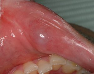 下唇に発生した粘液嚢胞。小唾液腺の開口部が閉塞し唾液が貯留したものです。治療法は外科的に取り除きます。