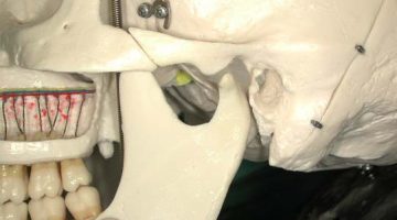 skull-TMJ