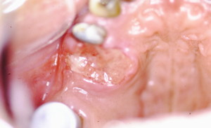 上顎歯肉癌